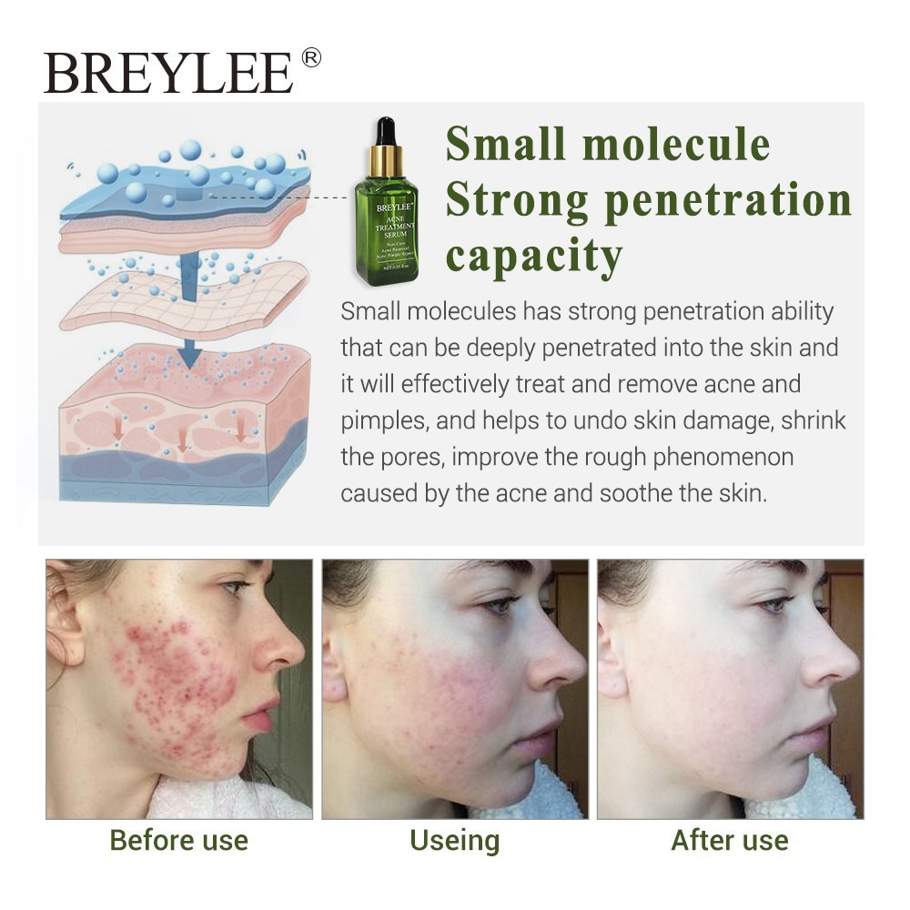 BREYLEE Acne Treatment Serum Face Facial Anti Acne Scar Removal Cream Skin Care Whitening Repair Pimple Remover For Acne - XMART