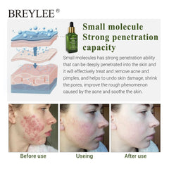 BREYLEE Acne Treatment Serum Face Facial Anti Acne Scar Removal Cream Skin Care Whitening Repair Pimple Remover For Acne - XMART