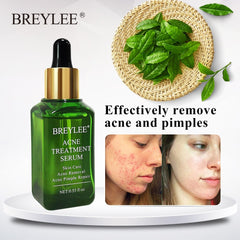 BREYLEE Acne Treatment Serum Face Facial Anti Acne Scar Removal Cream Skin Care Whitening Repair Pimple Remover For Acne - XMART